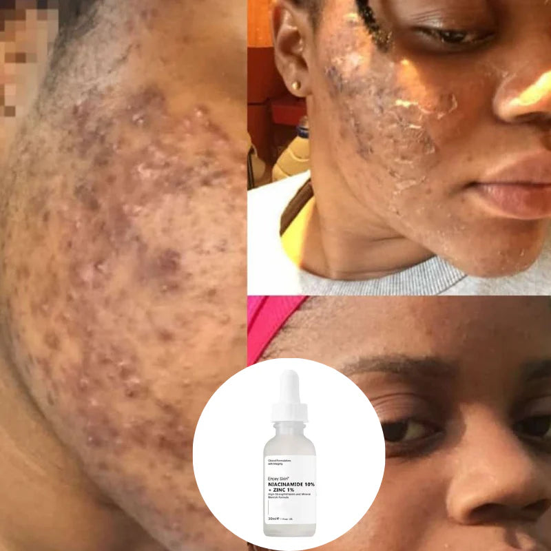 Le sérum The Ordinary Niacinamide